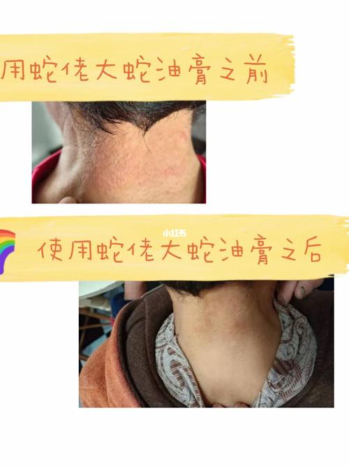 小朋友家长的妈妈脖子长皮癣,又红又痒,医院看过了各种药膏涂抹过都没