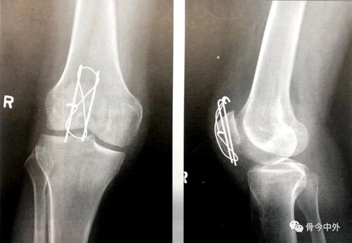 【骨科小技巧】髌骨骨折前张力带技术!