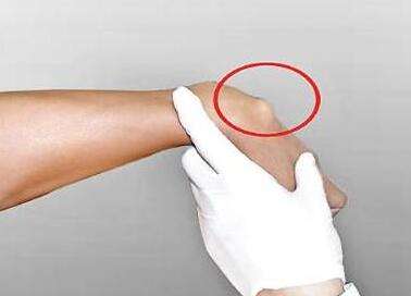 1.桡骨茎突狭窄性腱鞘炎