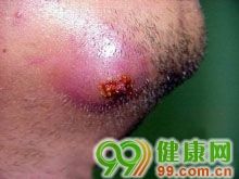 颜面部疖痈