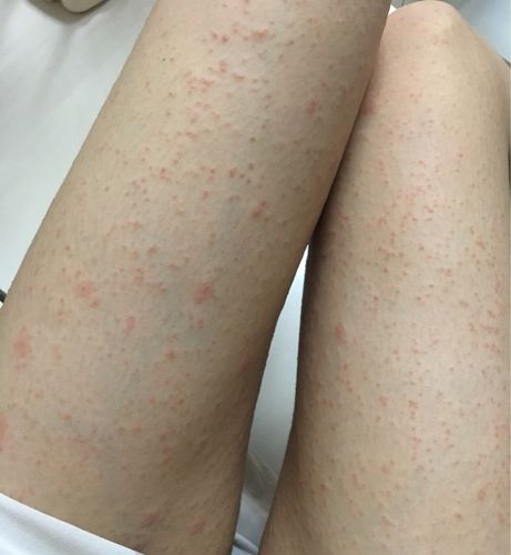 玫瑰糠疹的自愈以及平时要注意的 ?