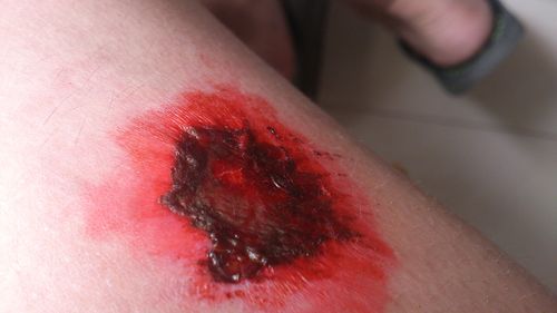 昨天去医院医生帮我把伤口中间剪开了说有脓血,然后擦那个橙黄色的