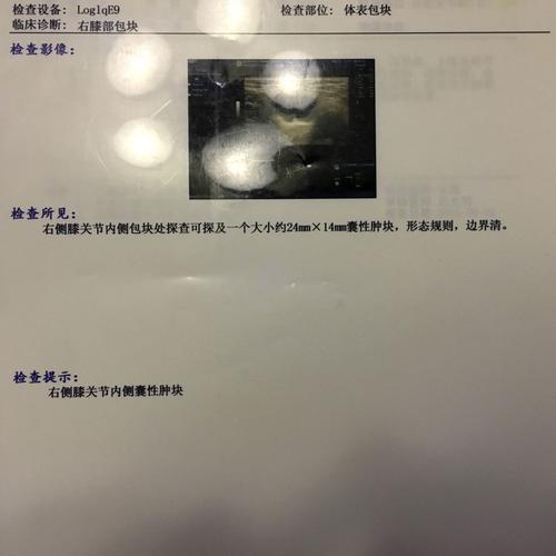 膝关节皮下有个小包,是什么囊肿?