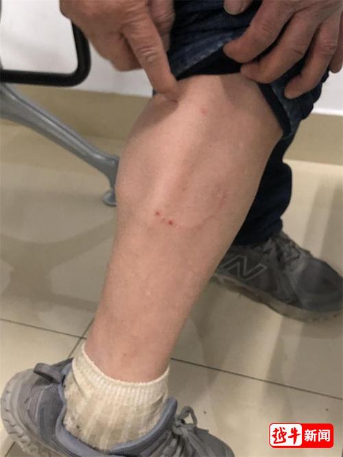 一位被狗咬伤的就诊老人,向医生展示伤情