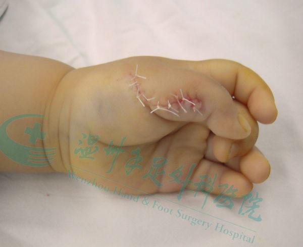 新生儿多大做多指手术比较好