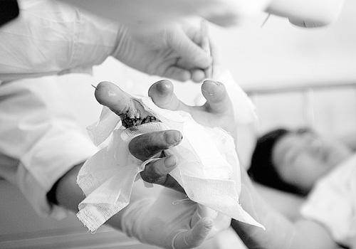 新闻中心 国内新闻 > 正文   伙文强接受了这一奇特的断指再植手术.