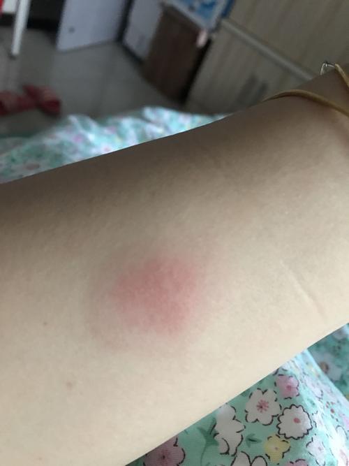 我做了ppd,今天是第二天,现在痒,还变好红一块,是不是感人肺结核了