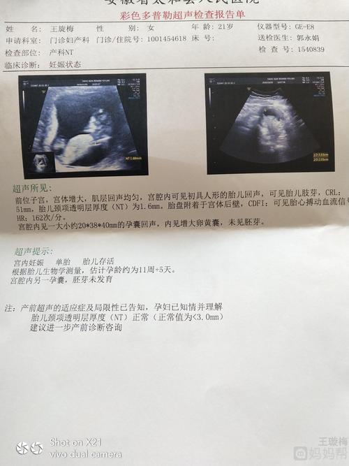 第一次b超是双胎 12周做nt变成了单