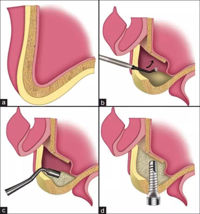 最近的研究有 · 上颌窦底提升植骨同期植入种植体