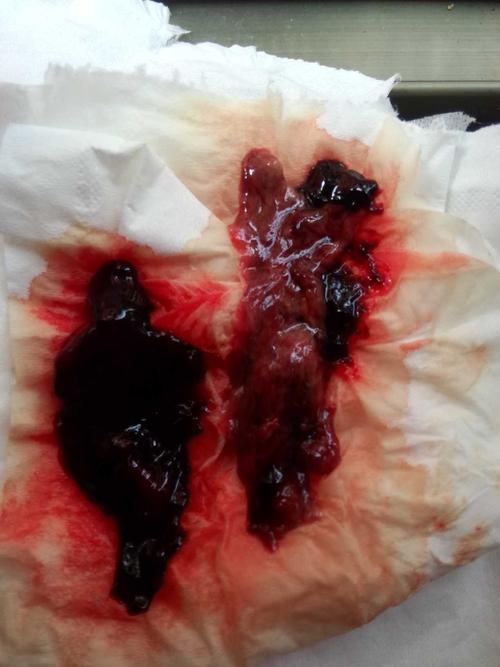 亲,看一下,这个是不是胎囊,刚肚子疼上厕所流出来的