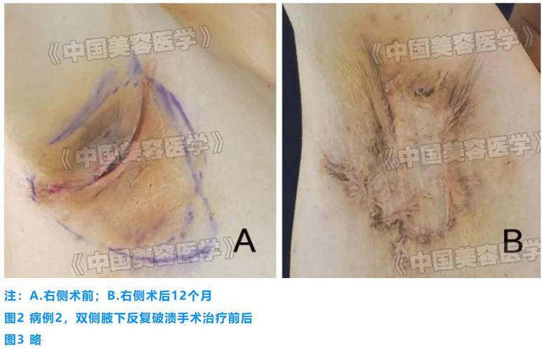 化脓性大汗腺炎的手术治疗