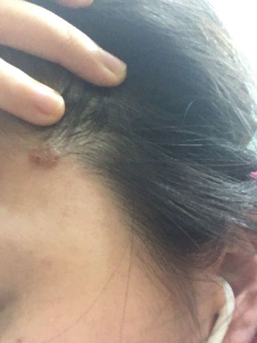 请问这个是痣还是疣,有图