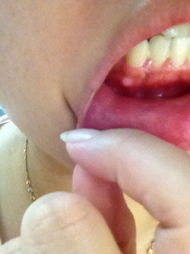 下面牙龈发现了这个白色的,很硬像骨头一样