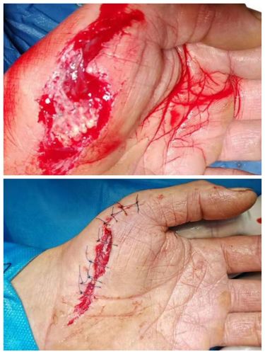 手掌部大面积皮肤缺损减张缝合术.