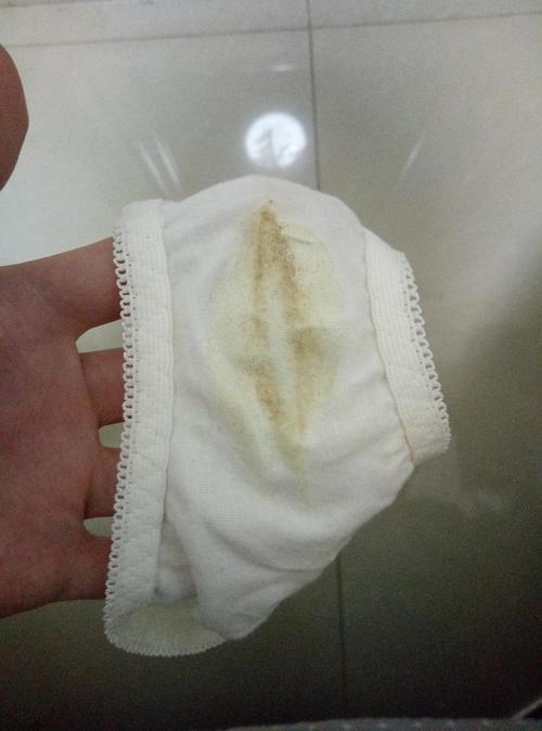 上个月白带可以拉丝是透明状的,然后没忍住吃了咸鱼和甜食,就又复发了