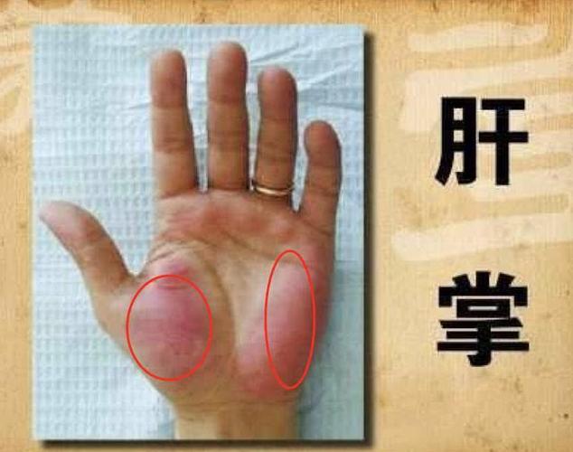 词儿,肝掌是指大拇指和小拇指根部往下部位(参见下图)的大小鱼际处