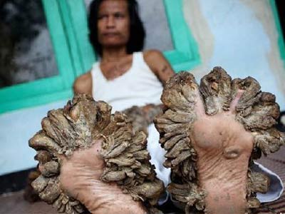 每天至少达到200多次性高潮的持续性性兴奋综合症,变成"树人"