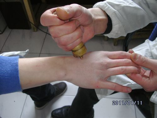 双手麻木的治疗心得