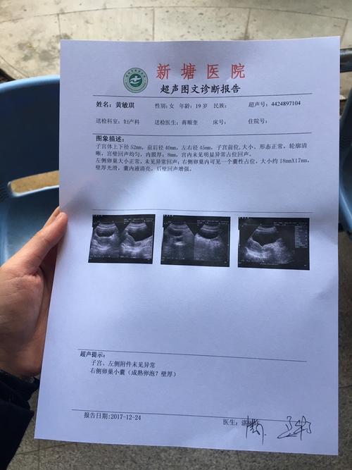 我是有卵巢囊肿吗?大吗?第一次备孕,没有怀孕过