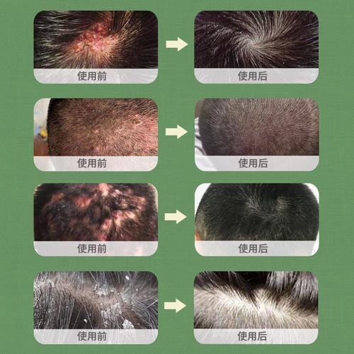 头皮皮毛囊炎头癣痒头头上痘痘抑菌止痒真菌皮肤消毒护理(消)