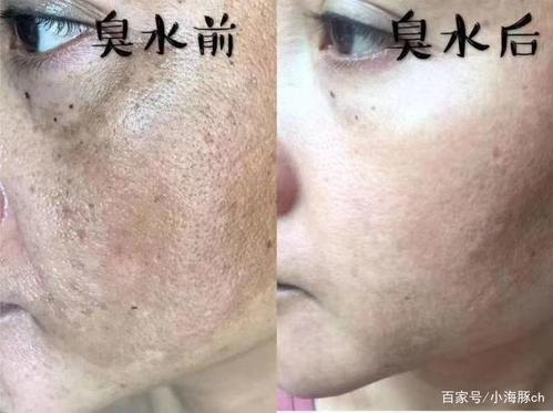 臭水脸上斑用前用后效果对比图