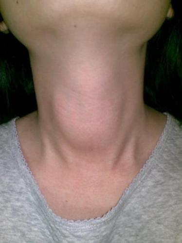 通过触诊也可以了解到,桥本病患者的甲状腺肿大与甲亢的肿大不同