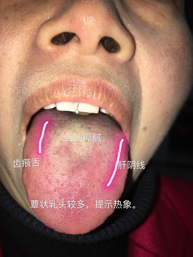 齿痕舌说明:脾虚.