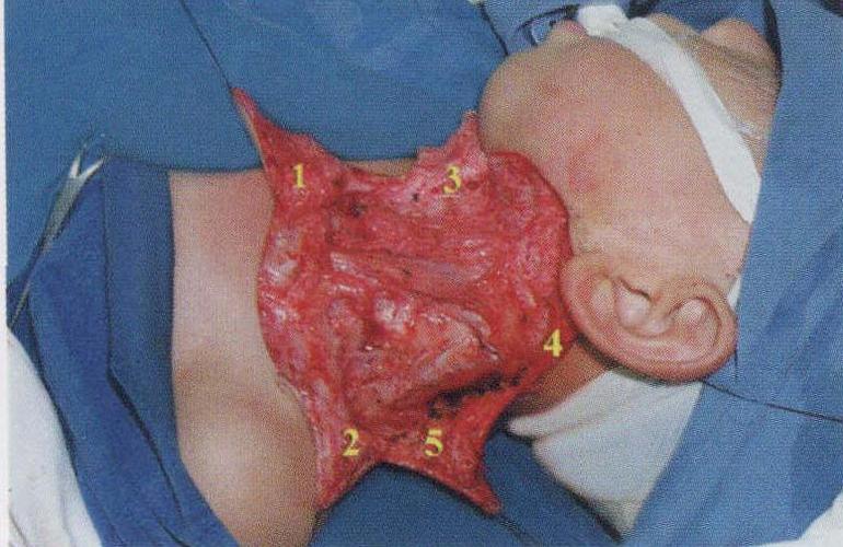 典型病例2:五瓣成形术矫正左侧颈前蹼状瘢痕挛缩畸形