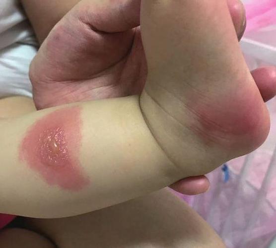 1岁婴儿被蚊子咬了一口,高烧不退被抢救,医生:晚一步