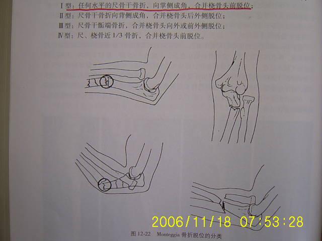 孟氏骨折(蒙太奇骨折)