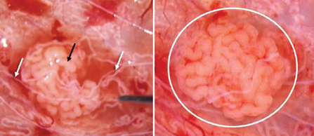 无精子症睾丸取精术全解析