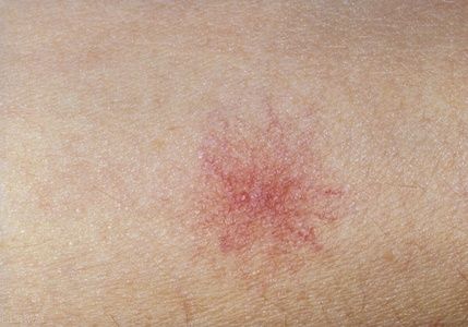 身上有癌,皮肤先知,当皮肤出现4种异常,警惕是癌症发出的信号