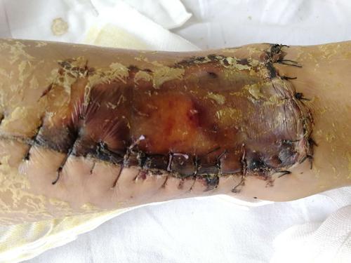 患者,女,52岁,摔伤右小腿出血,疼痛,畸形入院,诊断:右胫腓骨下段开放