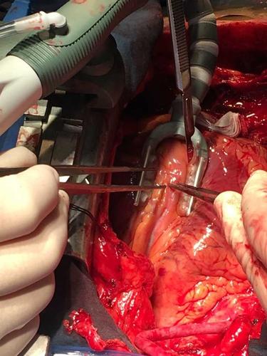 图中前降支近端位置有一个支架