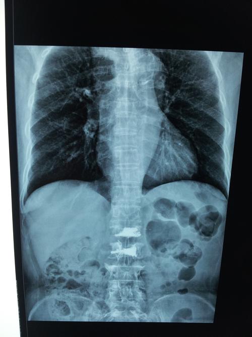 经椎弓根基地部穿刺pkp,出现骨水泥向椎管内漏