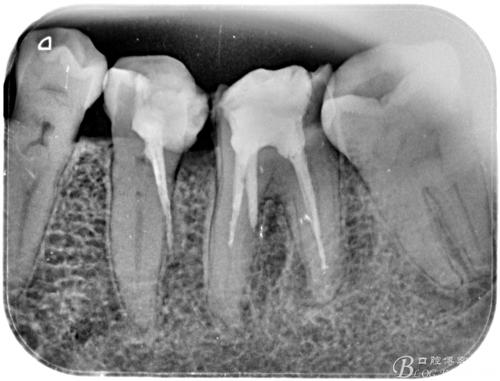 神奇的根管变异侧穿