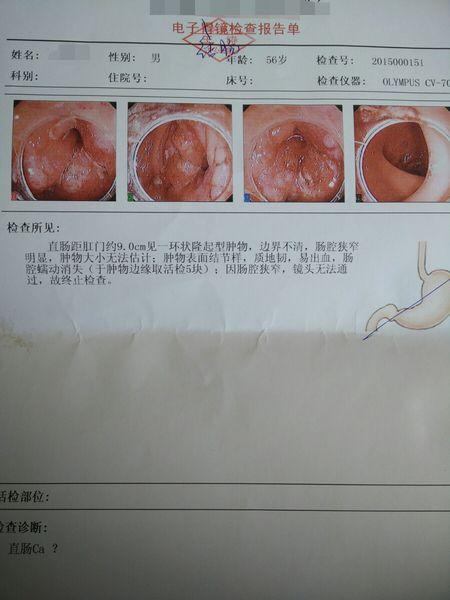 这么看是囊肿还是癌?能看出来么?我有更好的答案 分享到