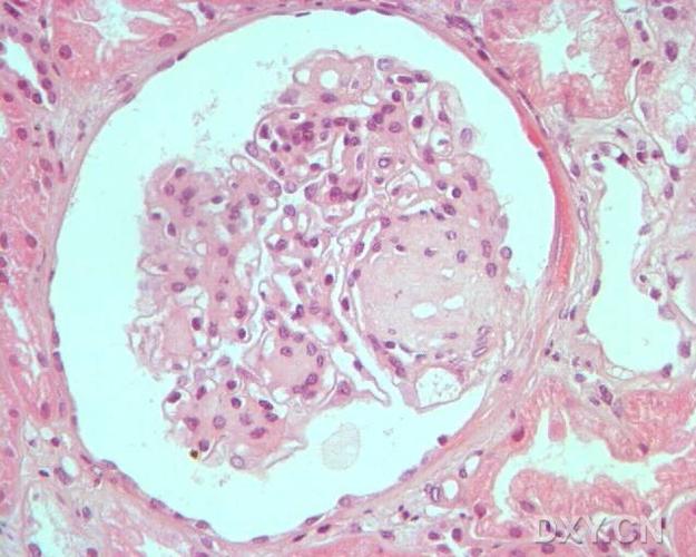 【资料】糖尿病肾病