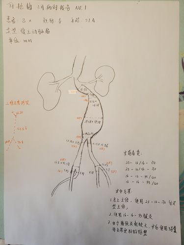 郭艳梅3月腹主动脉病例