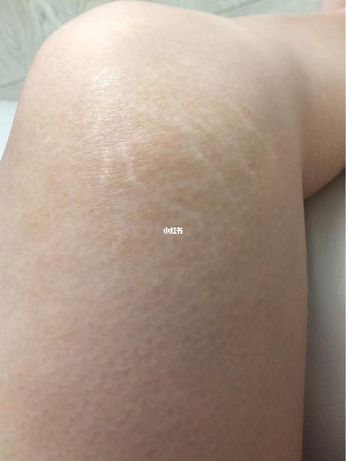 你们有这种白色的纹吗?_肥胖纹_生长纹_美妆_个人护理