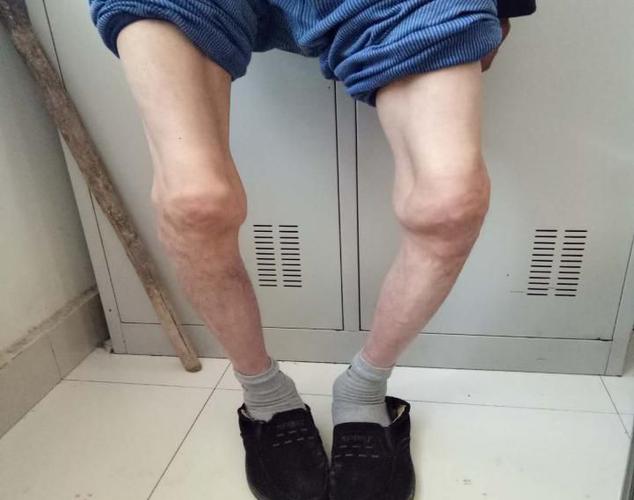 科室接诊的膝关节骨性关节炎患者术前照片