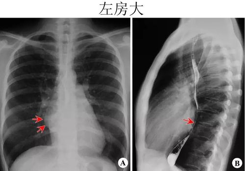 心脏x线表现