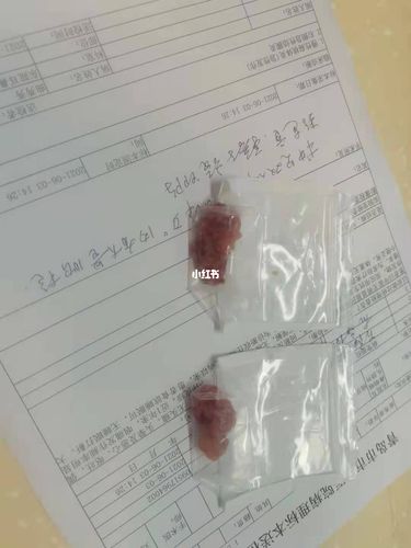 扁桃体切除_扁桃体_医疗健康_医疗健康其他