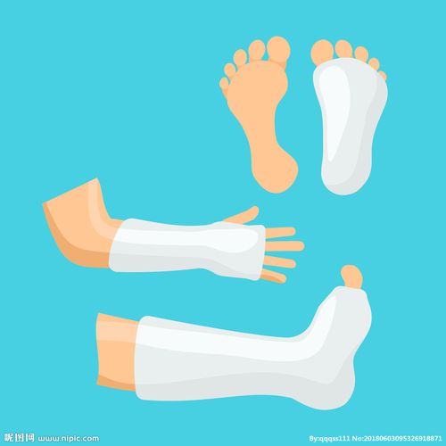 打石膏手脚医疗治理素材骨折保护图片