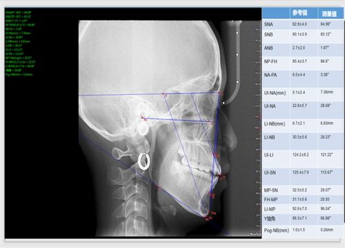 治疗前头颅侧位片,口内照 上:治疗前 下:治疗后患者基本满意,侧貌