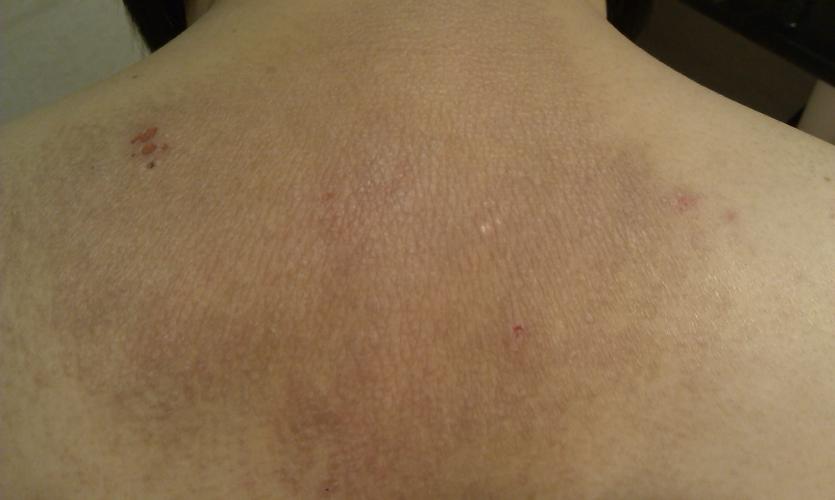 20:54469459490a|来自手机知道|三级 真菌感染 追问 是神经性皮炎