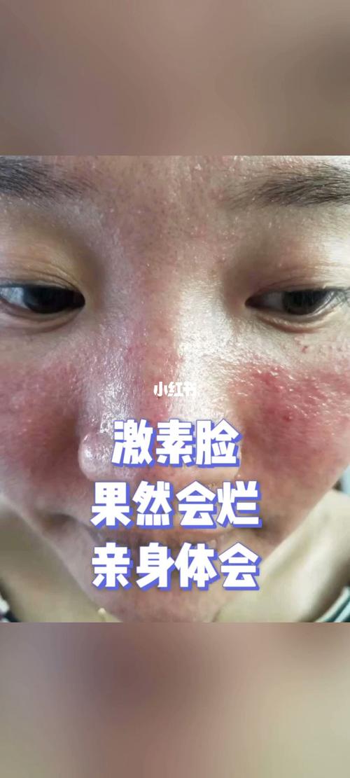 激素脸排毒必须要经历烂脸过程吗?