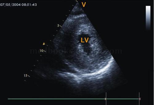 2·m型超声心动图 (1)梗阻者二尖瓣c‐d段呈多层弓背样隆起,称为sam