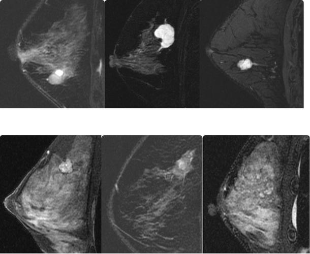 南皮县人民医院开展乳腺磁共振检查