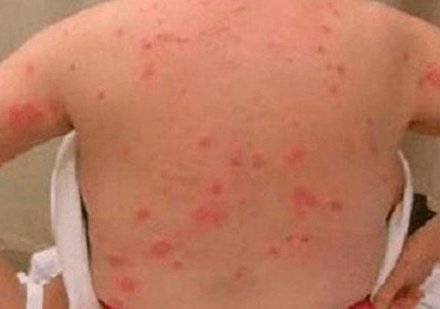 床上螨虫咬的症状图片什么样子及治疗与臭虫叮咬